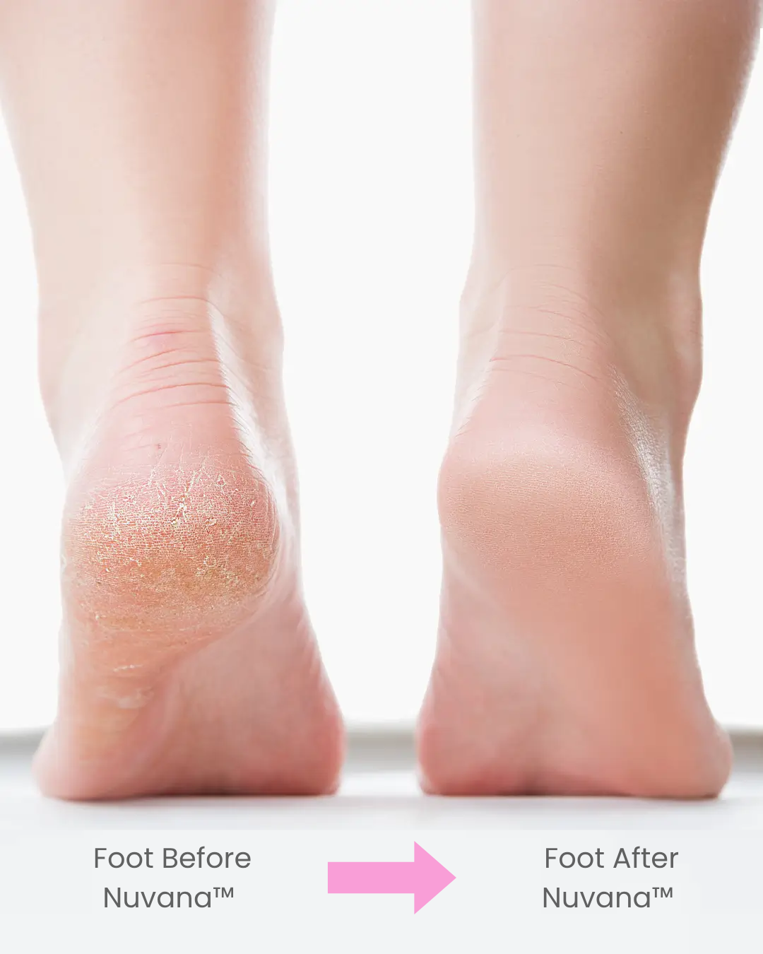 Nuvana™ Pedi Pro 3.0